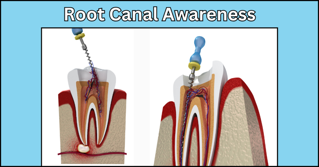 Root Canal Awareness