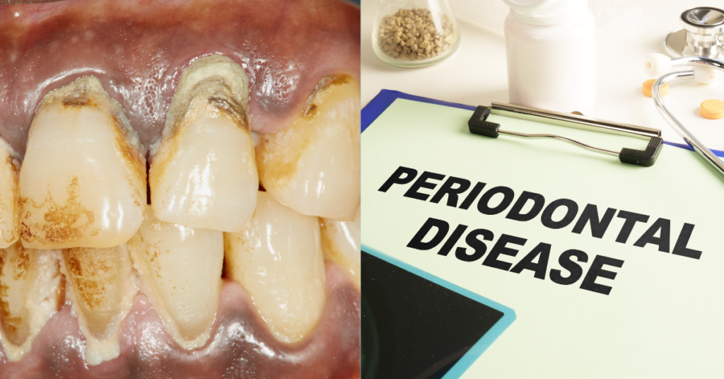 Gum Disease (Periodontitis)