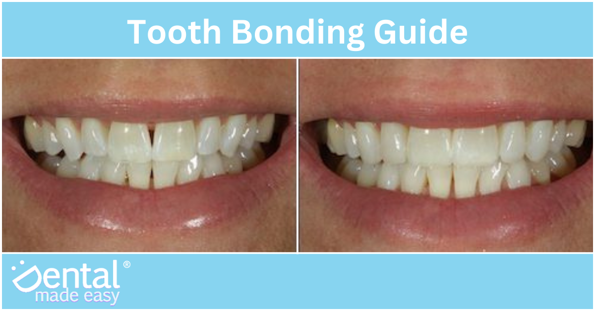 Tooth Bonding Guide