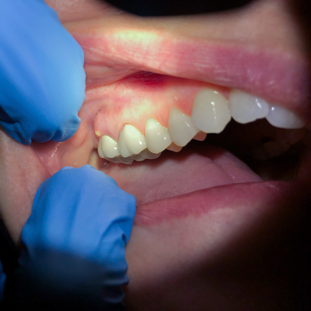 Tooth Abscess and Its Treatment