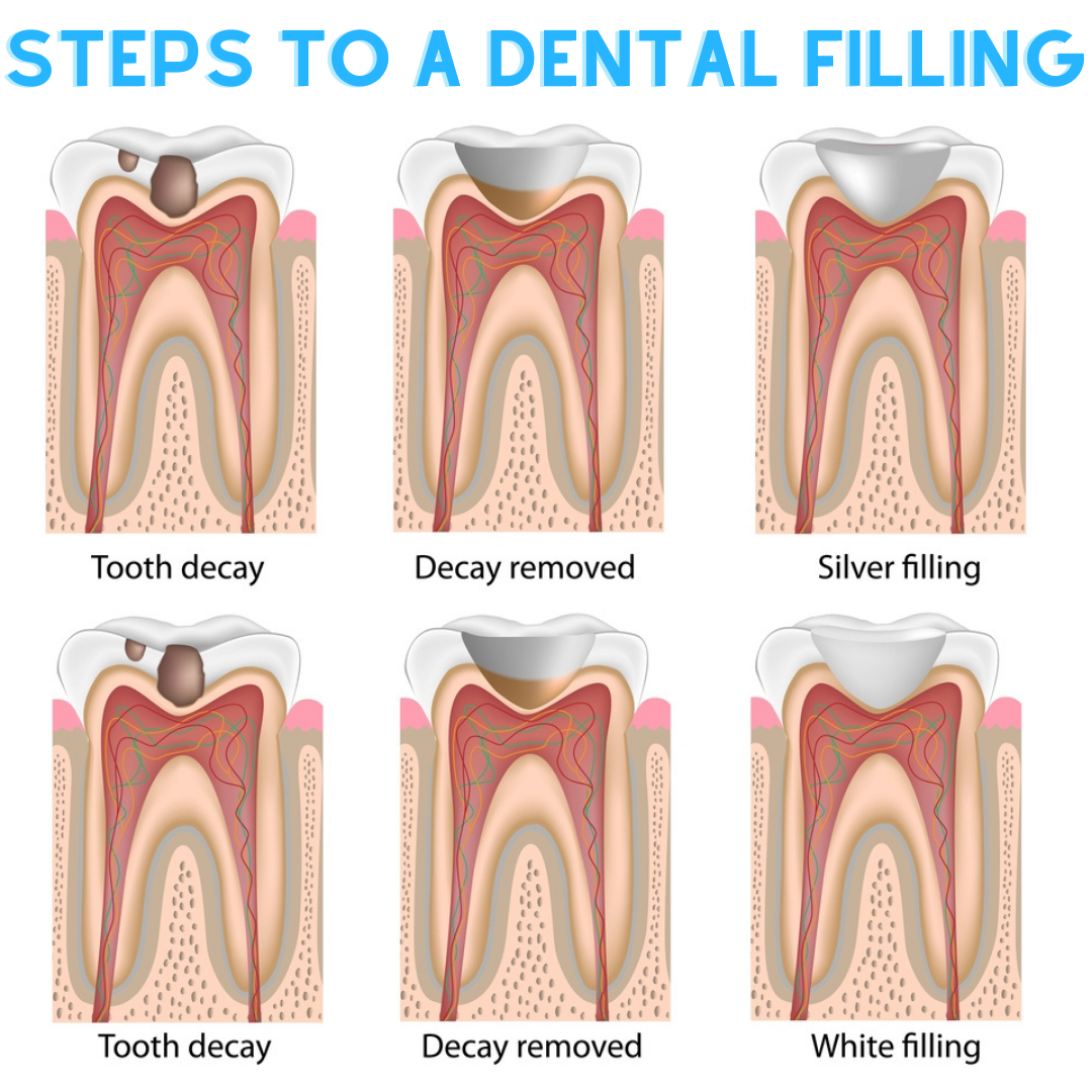 Step-by-Step Dental Filling Procedure: How Does It Work? - Mint