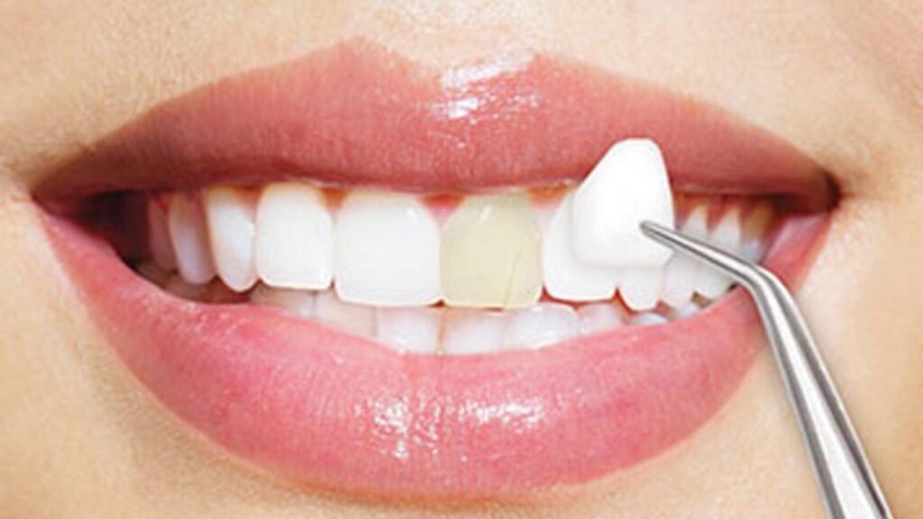 Dental Veneers Dental Made Easy