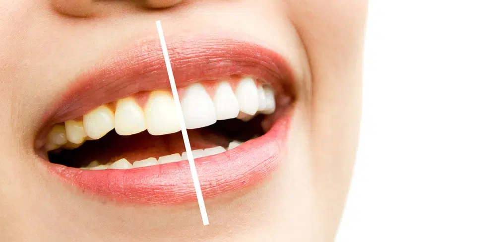 Teeth Whitening