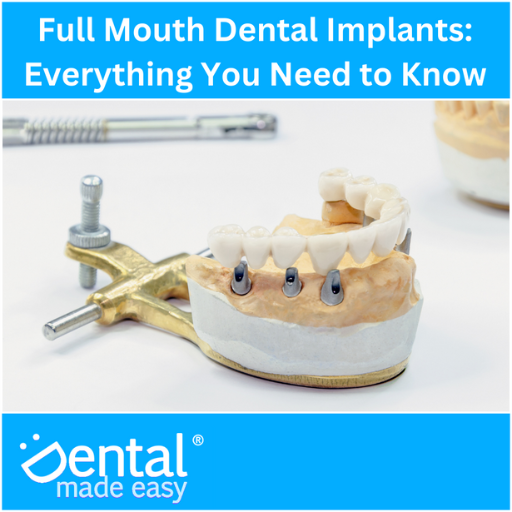 Full Mouth Dental Implants: Everything You Need to Know