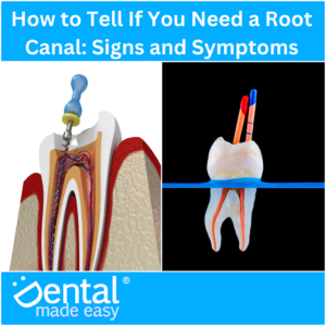 How to Tell If You Need a Root Canal: Signs and Symptoms