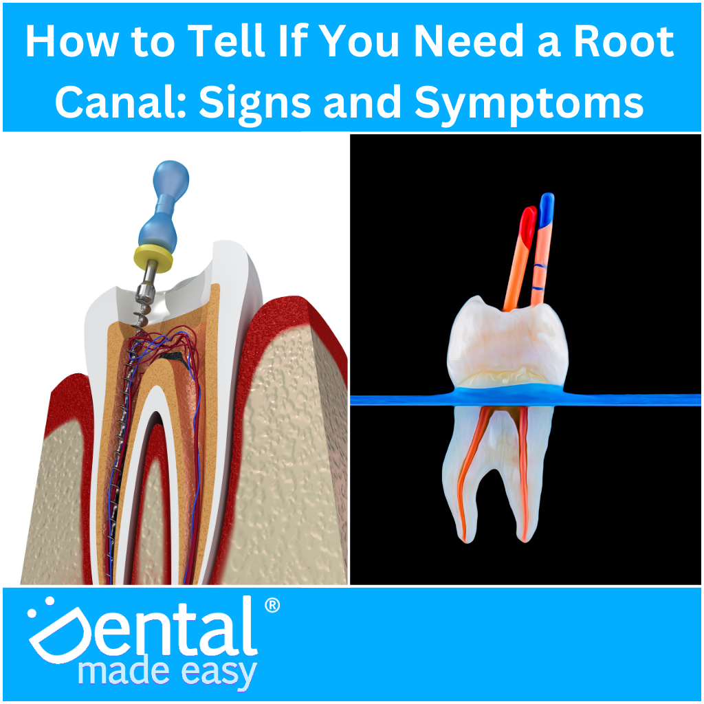 How to Tell If You Need a Root Canal: Signs and Symptoms