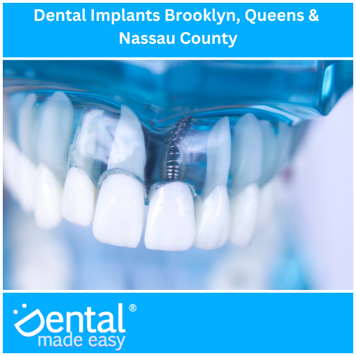 Dental Implants Brooklyn, Queens & Nassau County