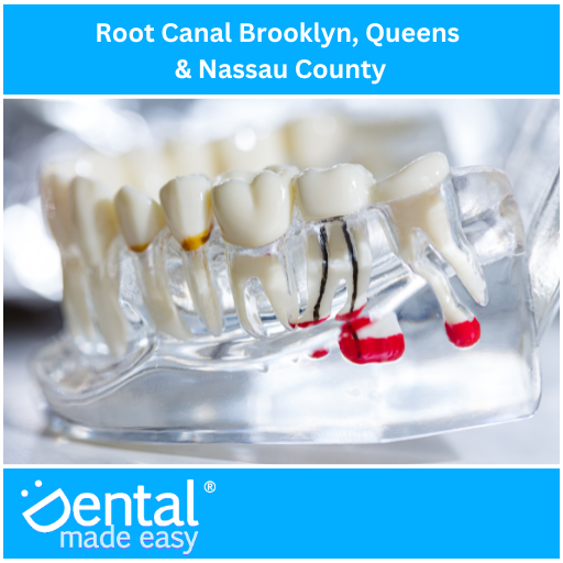 Root Canal Brooklyn, Queens & Nassau County