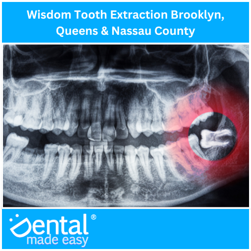 Wisdom Tooth Extraction Brooklyn, Queens & Nassau County
