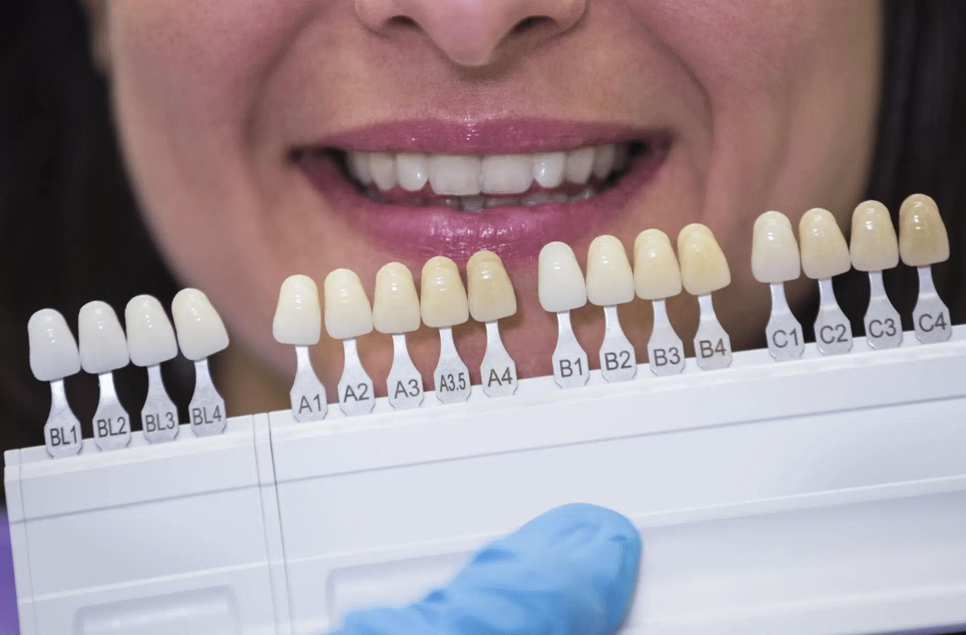 teeth-veeners