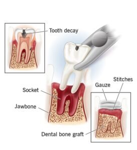 Tooth Extraction | Types of Extractions | Dental Made Easy