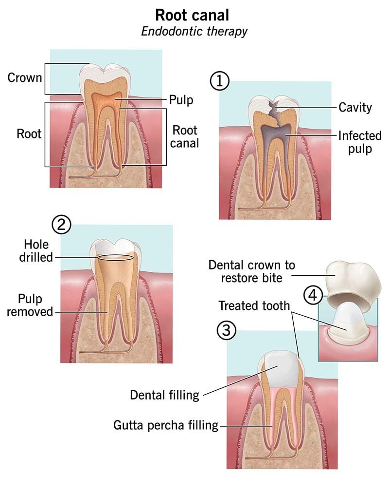 Root Canal