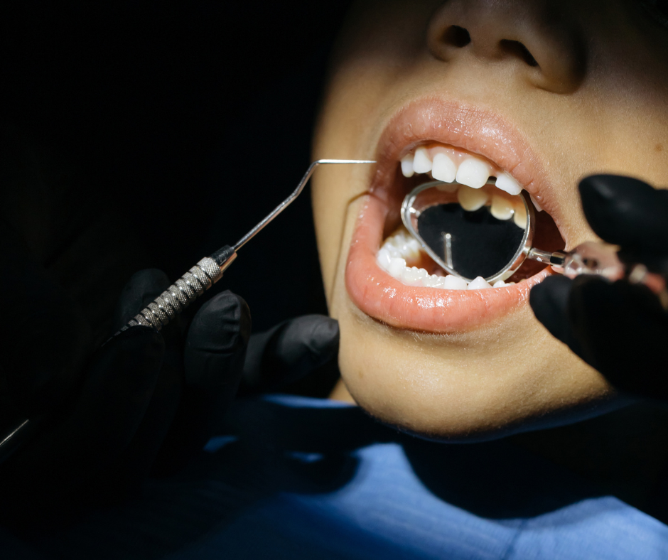 Dental fillings - Dental Made Easy