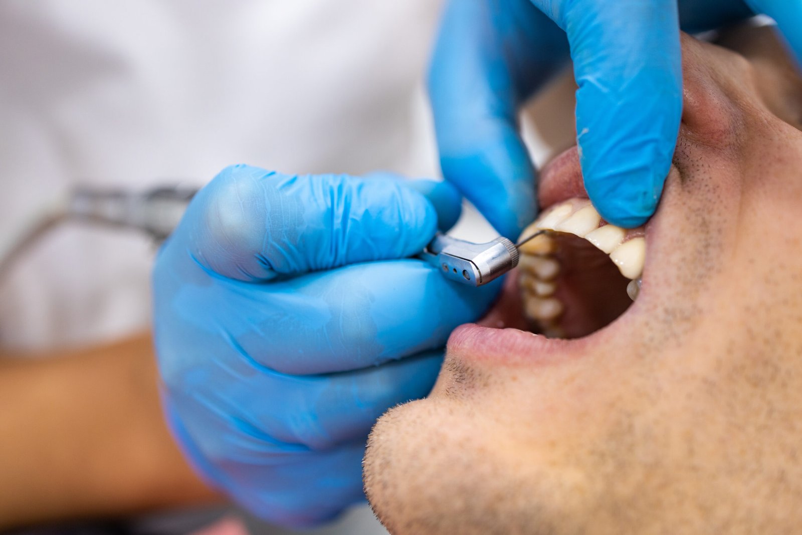 Tooth extraction - Dental Made Easy