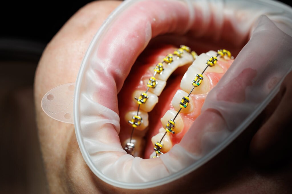 Yellow Teeth Causes | Dental Made Easy Clinic