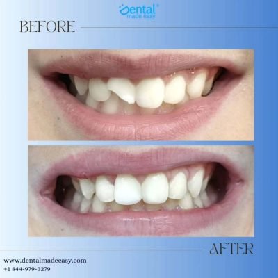 chipped tooth before and after chipped tooth before and after